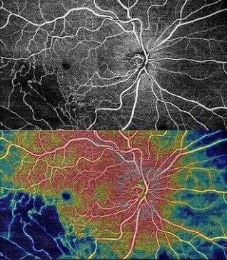 oct-optik-koherenz-tomografi-anjiyografisi
