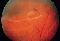 retina-yirtigi-ve-dekolamani