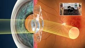 sari-nokta-merceginin-goruntuyu-saglam-retina-kaydirmasi