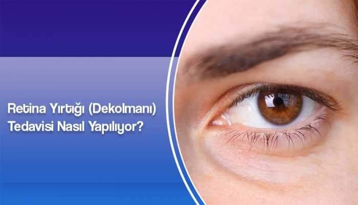 retina-yirtigi-dekolmani-tedavisi-nasil-yapiliyor-ates-yanyali