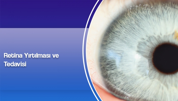 retina-yirtilmasi-ve-tedavisi-ates-yanyali