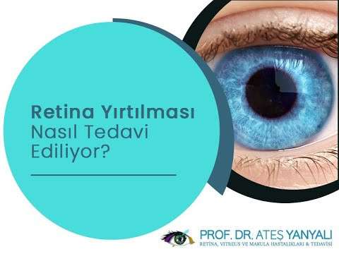 Retina yırtılması,Retina yırtılması nasıl tedavi ediliyor,retina hastalıkları