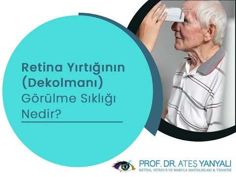 retina yırtılması,retina dekolmanı,retina yırtığı görülme sıklığı,ateş yanyalı,doç dr ateş yanyalı