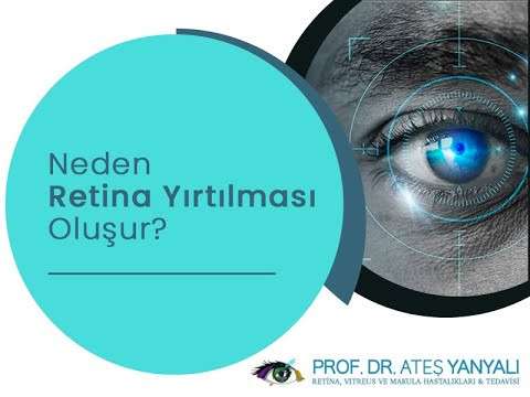 retina yırtılması,retina neden yırtılır,retina doktoru,retina uzmanı,doç dr ateş yanyalı