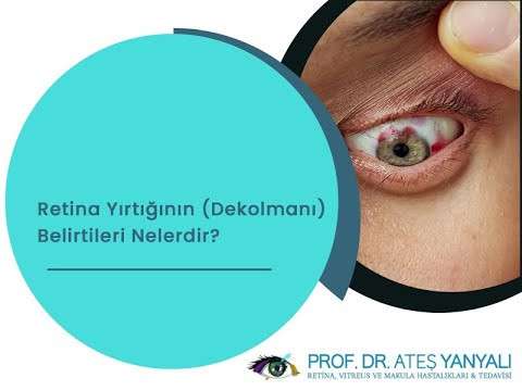 retina yırtığı,retina dekolmanı,retina yırtığı belirtileri,retina yırtığı nedenleri