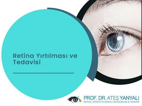 retina yırtılması,retina nedir,retina yırtılması nedir,diyabet hastalığı,şeker hastalığı,sarı nokta hastalığı,ateş yanyalı,doç dr ateş yanyalı