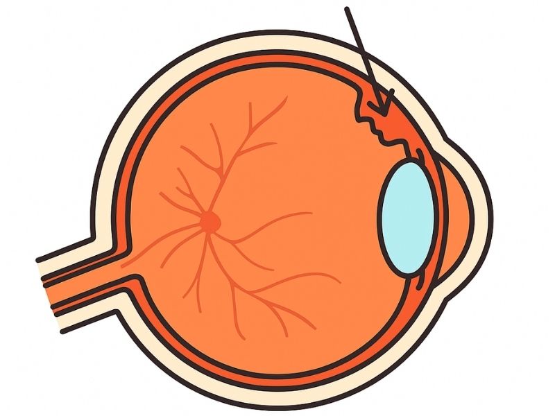 retina-nasil-yirtilir