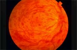 ana-toplardamar-tikanikligi