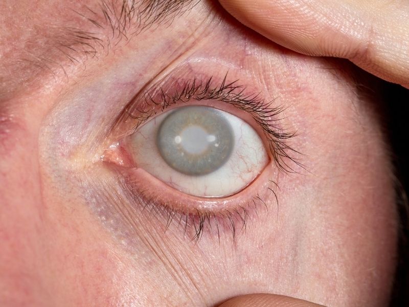 katarakt-ameliyati-kimlere-yapilabilir