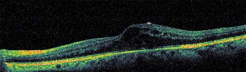 retina-ven-tikanikliginda-ne-tedavi-uyguluyoruz