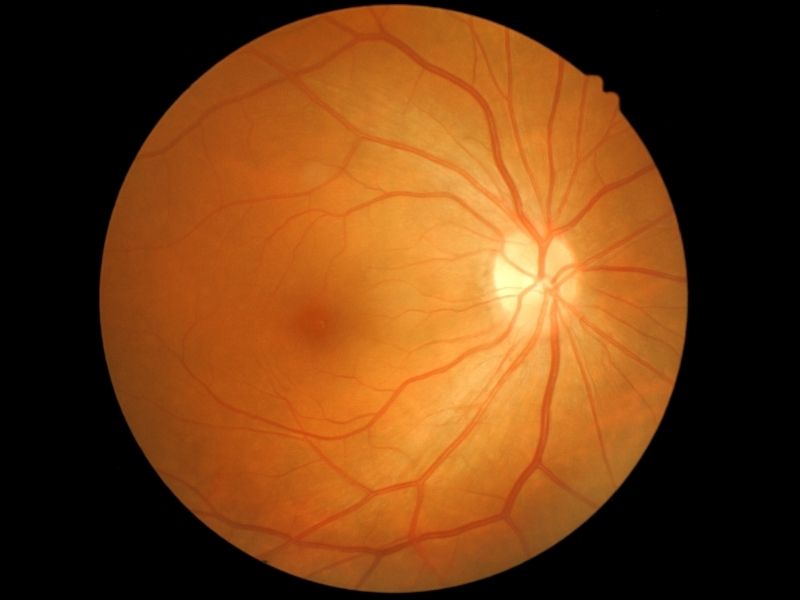 retina-yirtilmasi-sebepleri