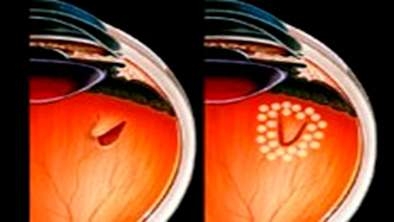 retina-yirtilmasi-tedavisi-nasil-yapilir