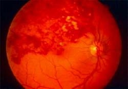 toplardamar-dal-tikanikligi