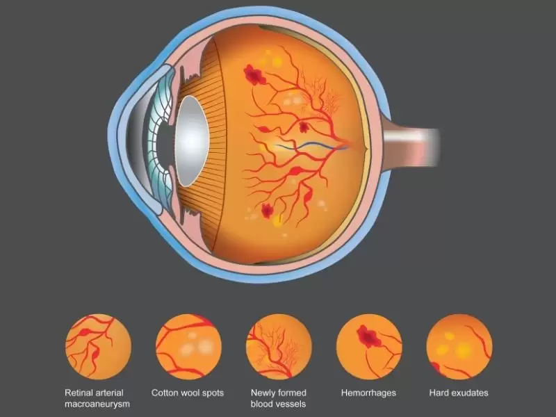 diyabetin-goz-sagligina-etkileri