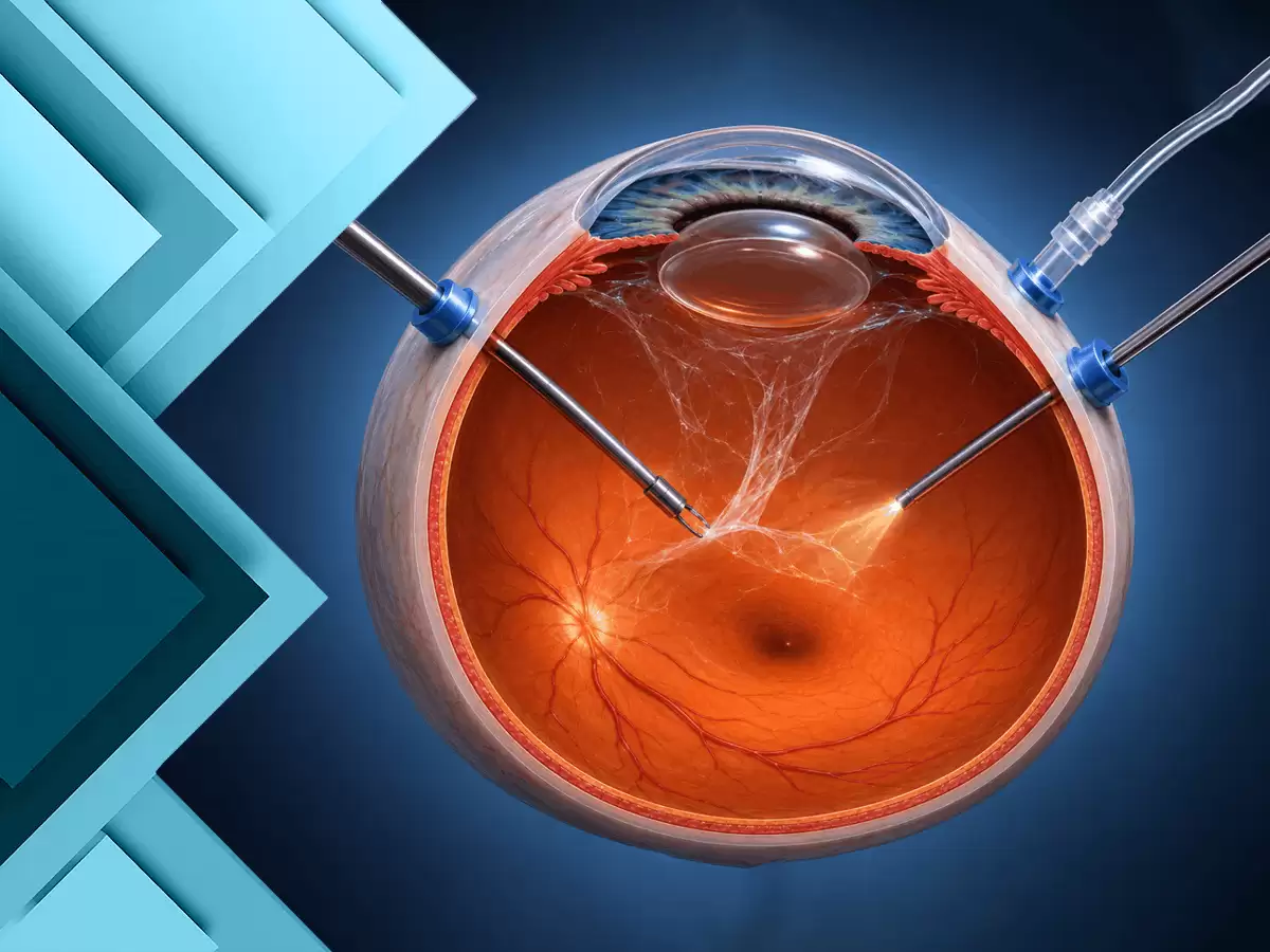 Retina, Sarı Nokta ve Vitreus Hastalıkları ve Cerrahisi