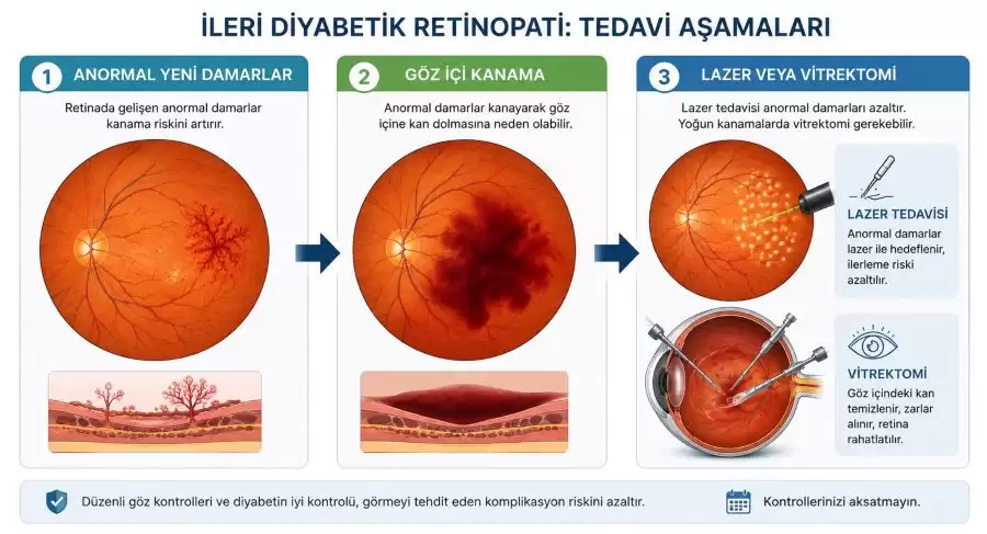 diyabetik-retinopatide-lazer-ne-zaman-yapilir