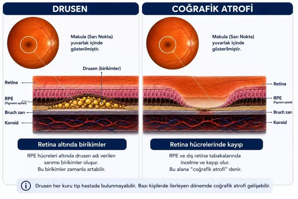 drusen-cografik-atrofi-sematik