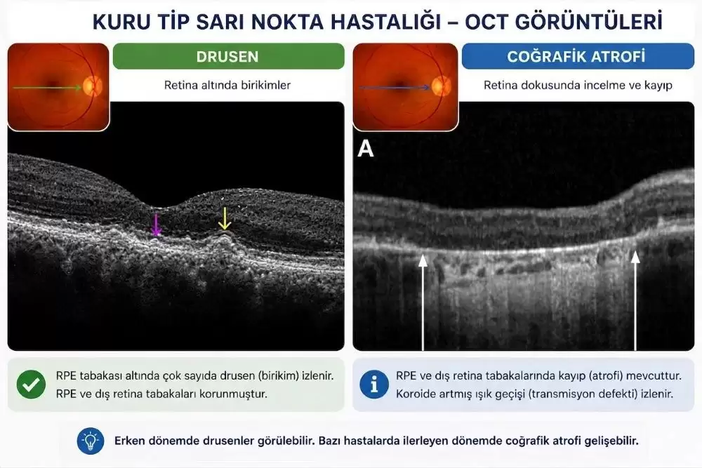 kuru-tip-sari-nokta-oct-drusen-cografik-atrofi
