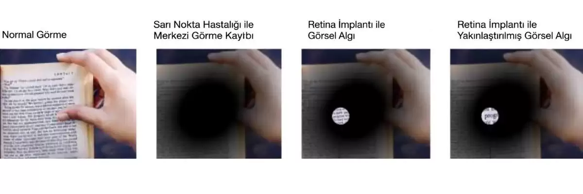 sari-nokta-hastaliginda-merkezi-gorme-kaybi-ve-retina-implanti-ile-gorsel-algi-simulasyonu