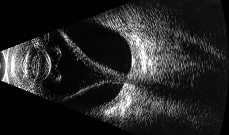 B-scan göz ultrasonunda retina dekolmanı görüntüsü