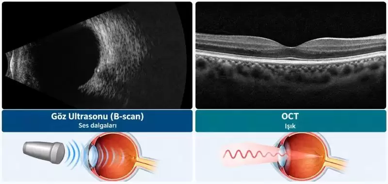Göz ultrasonu B-scan ile OCT görüntüleme yöntemlerinin karşılaştırılması