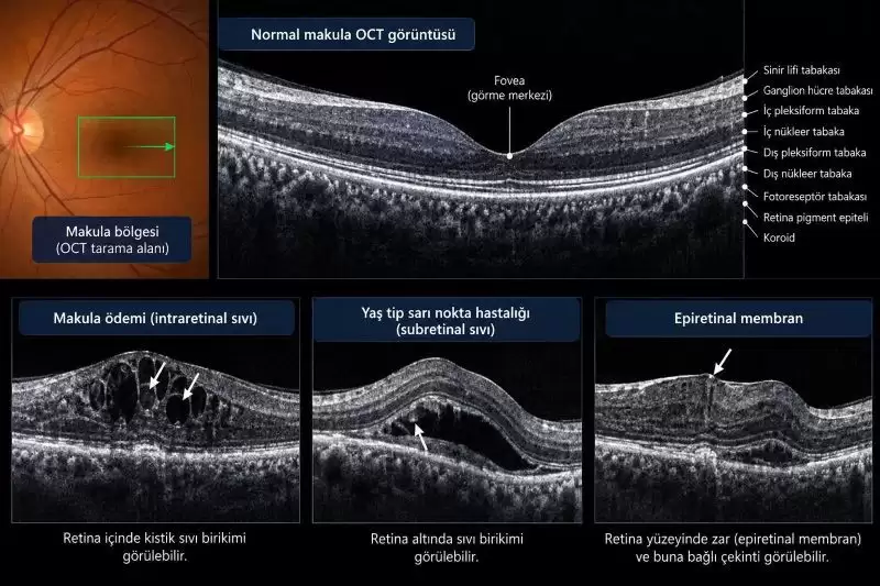 OCT görüntülerinde normal makula, makula ödemi, subretinal sıvı ve epiretinal membran örnekleri